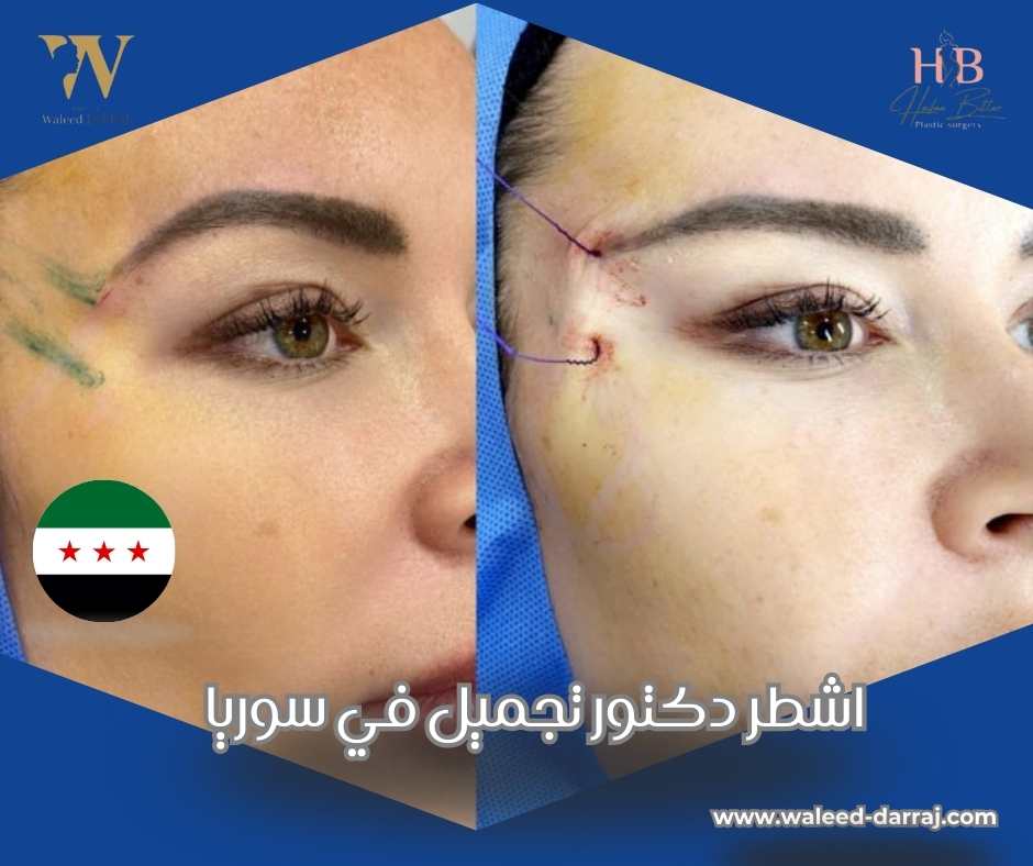 اشطر دكتور تجميل في سوريا