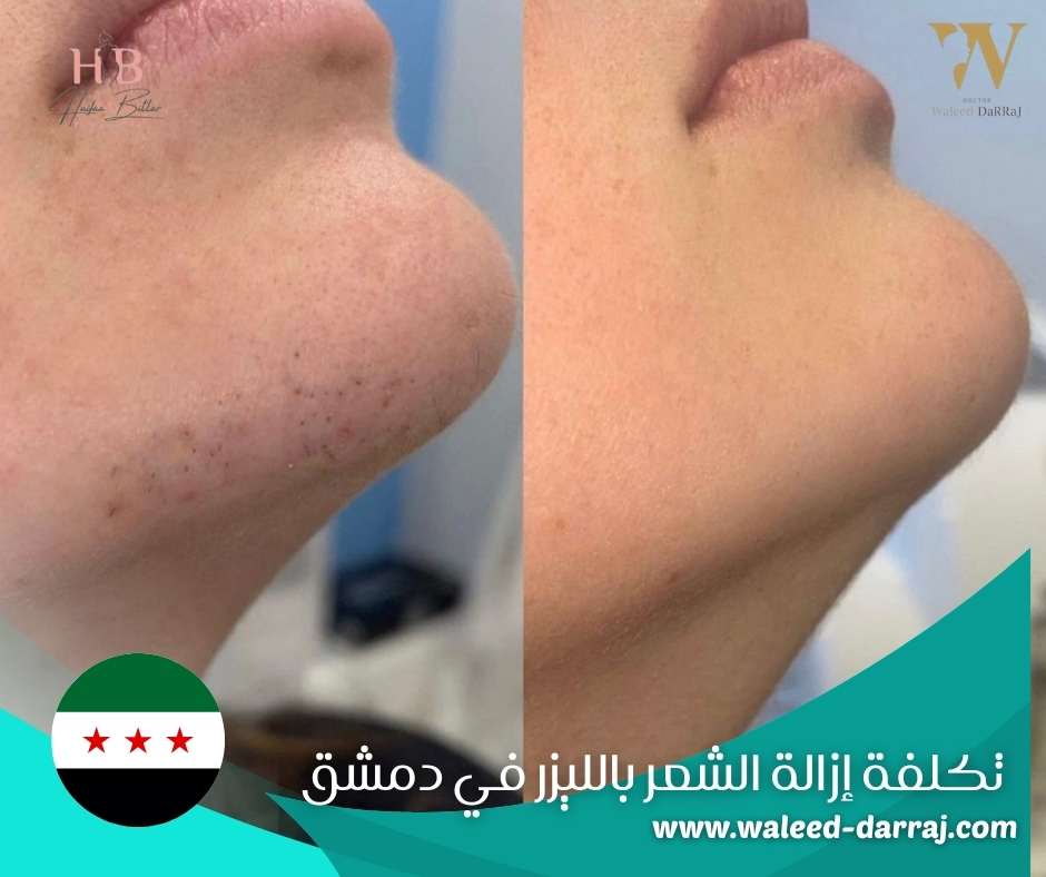 تكلفة إزالة الشعر بالليزر في دمشق