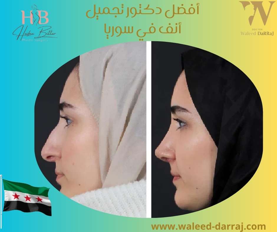 أفضل دكتور تجميل أنف في سوريا