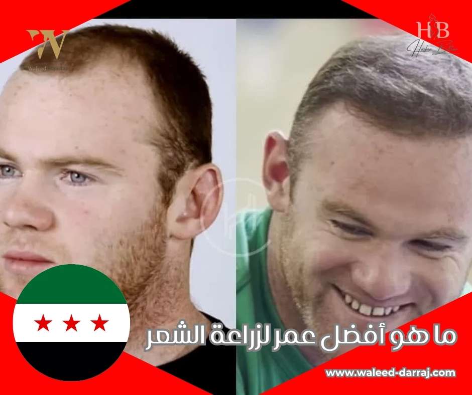 ما هو أفضل عمر لزراعة الشعر