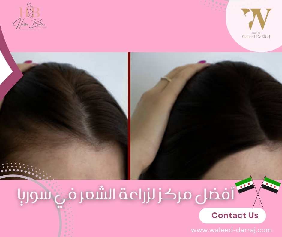 أفضل مركز لزراعة الشعر في سوريا