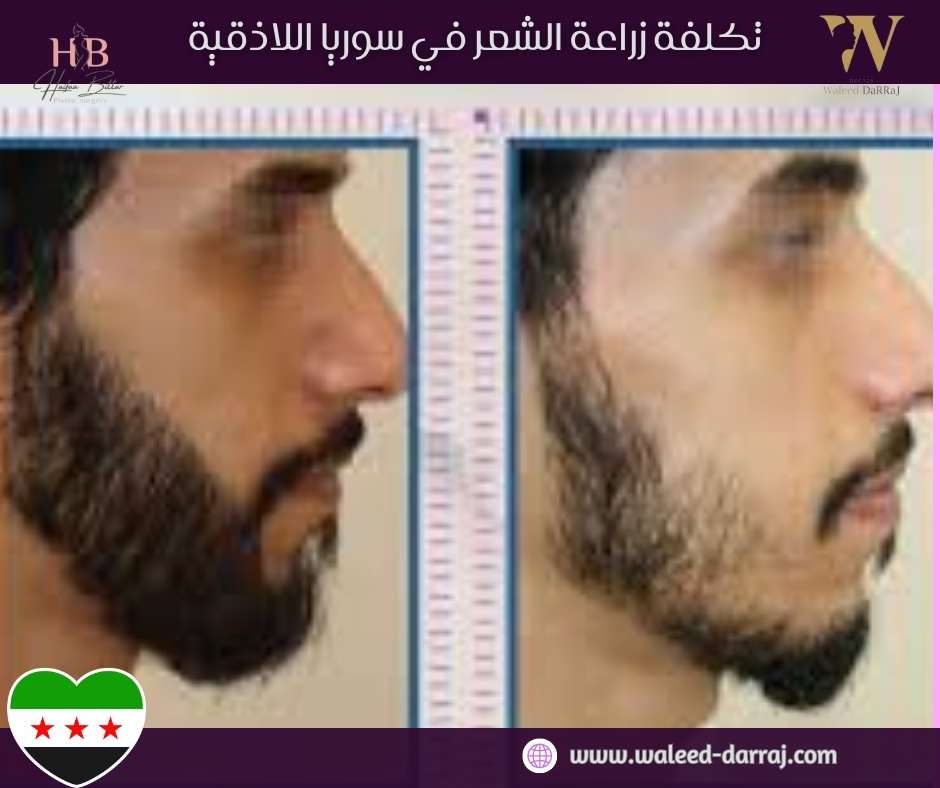 تكلفة زراعة الشعر في سوريا اللاذقية