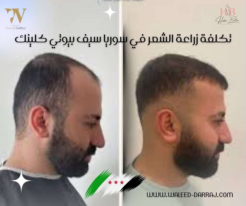 تكلفة زراعة الشعر في سوريا سيف بيوتي كلينك
