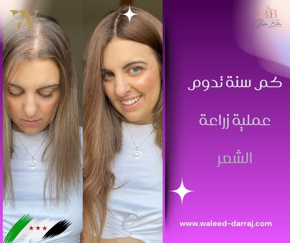 كم سنة تدوم عملية زراعة الشعر؟