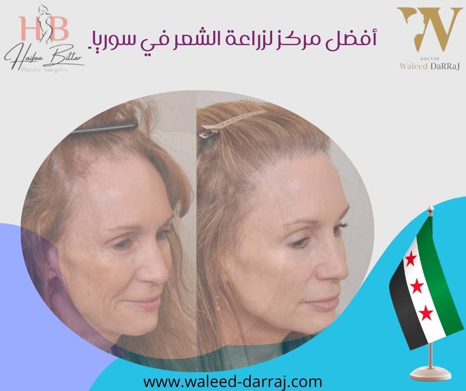 أفضل مركز لزراعة الشعر في سوريا