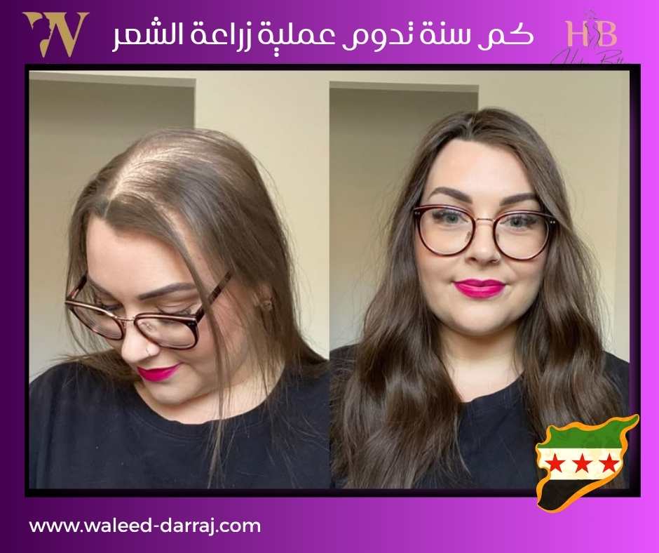 كم سنة تدوم عملية زراعة الشعر؟