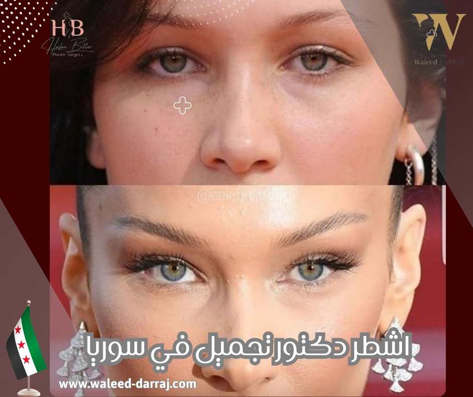 اشطر دكتور تجميل في سوريا
