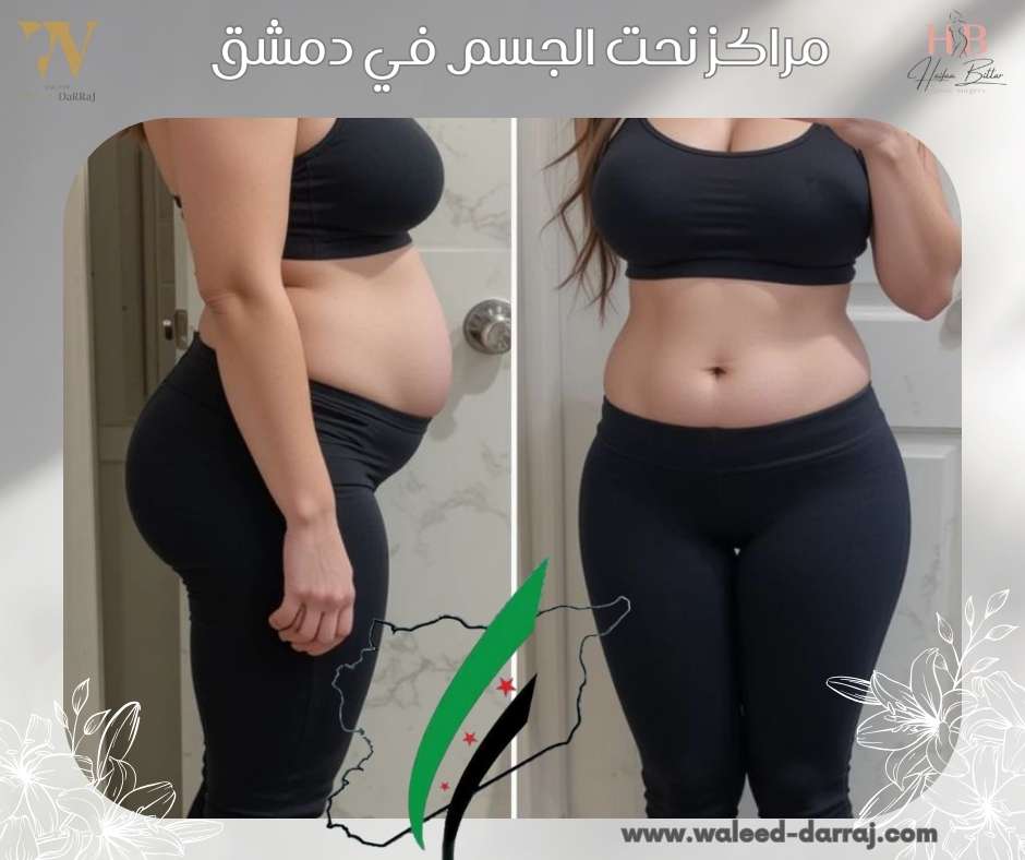 مراكز نحت الجسم في دمشق