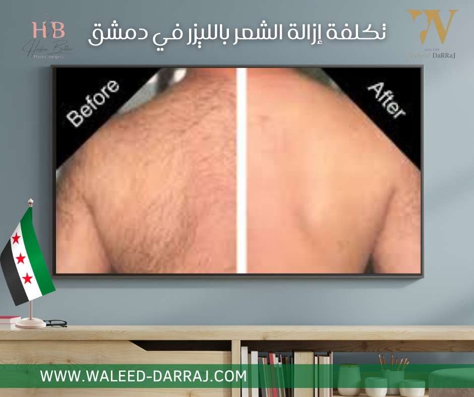 تكلفة إزالة الشعر بالليزر في دمشق