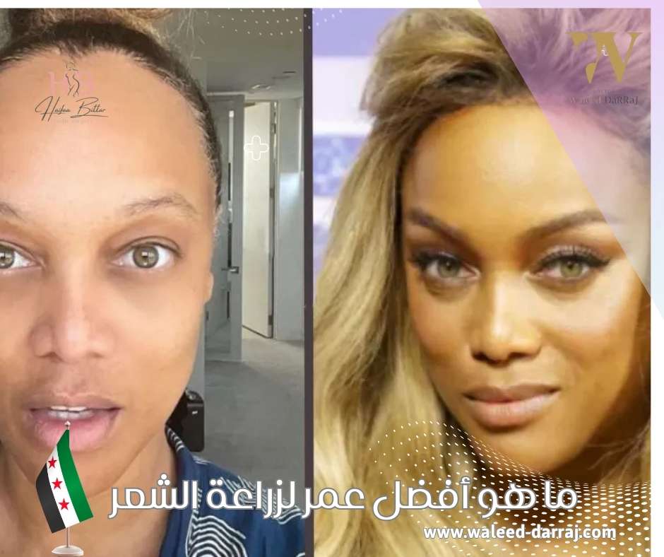 ما هو أفضل عمر لزراعة الشعر