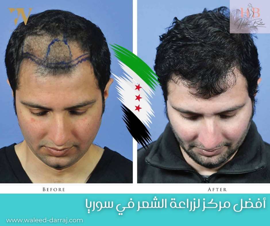 أفضل مركز لزراعة الشعر في سوريا