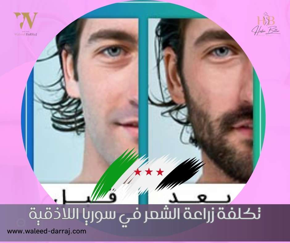 تكلفة زراعة الشعر في سوريا اللاذقية