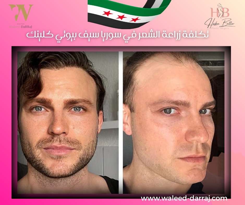 تكلفة زراعة الشعر في سوريا سيف بيوتي كلينك