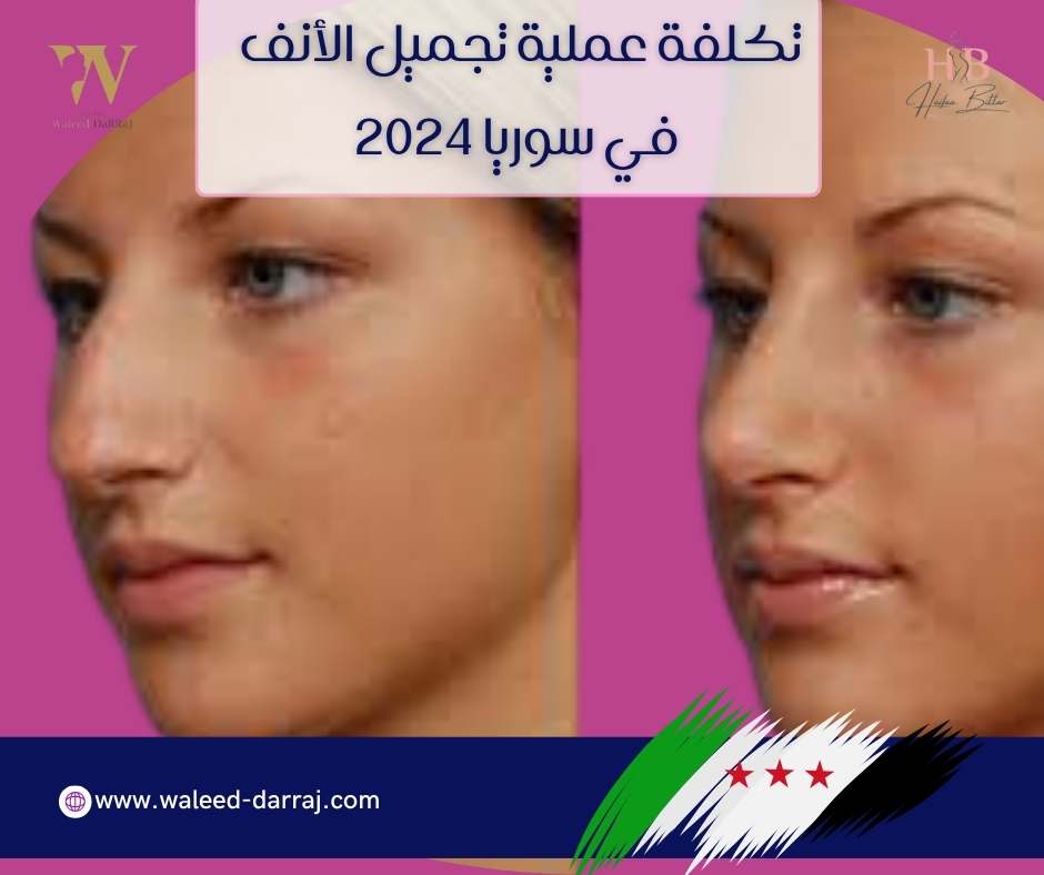 تكلفة عملية تجميل الأنف في سوريا 2024