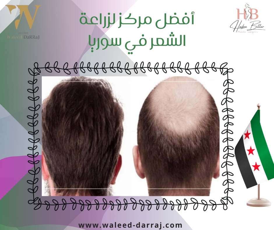 أفضل مركز لزراعة الشعر في سوريا