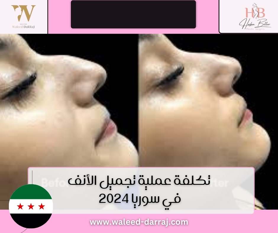 تكلفة عملية تجميل الأنف في سوريا 2024