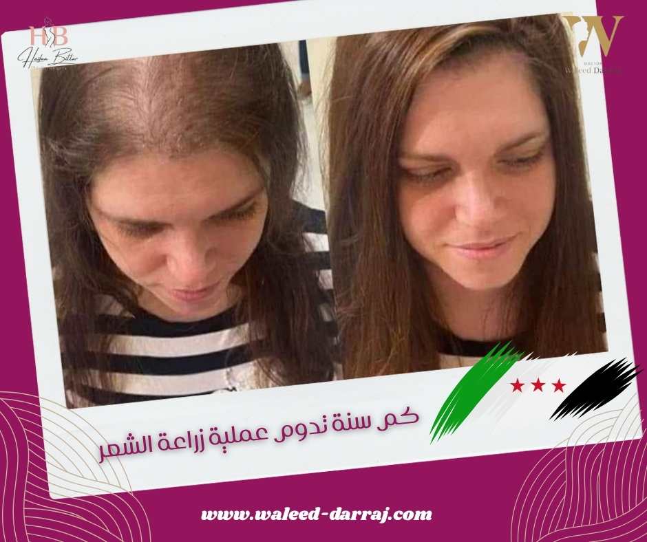 كم سنة تدوم عملية زراعة الشعر؟