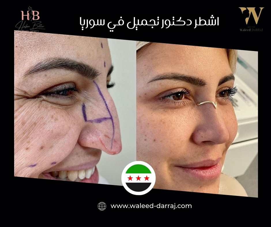 اشطر دكتور تجميل في سوريا