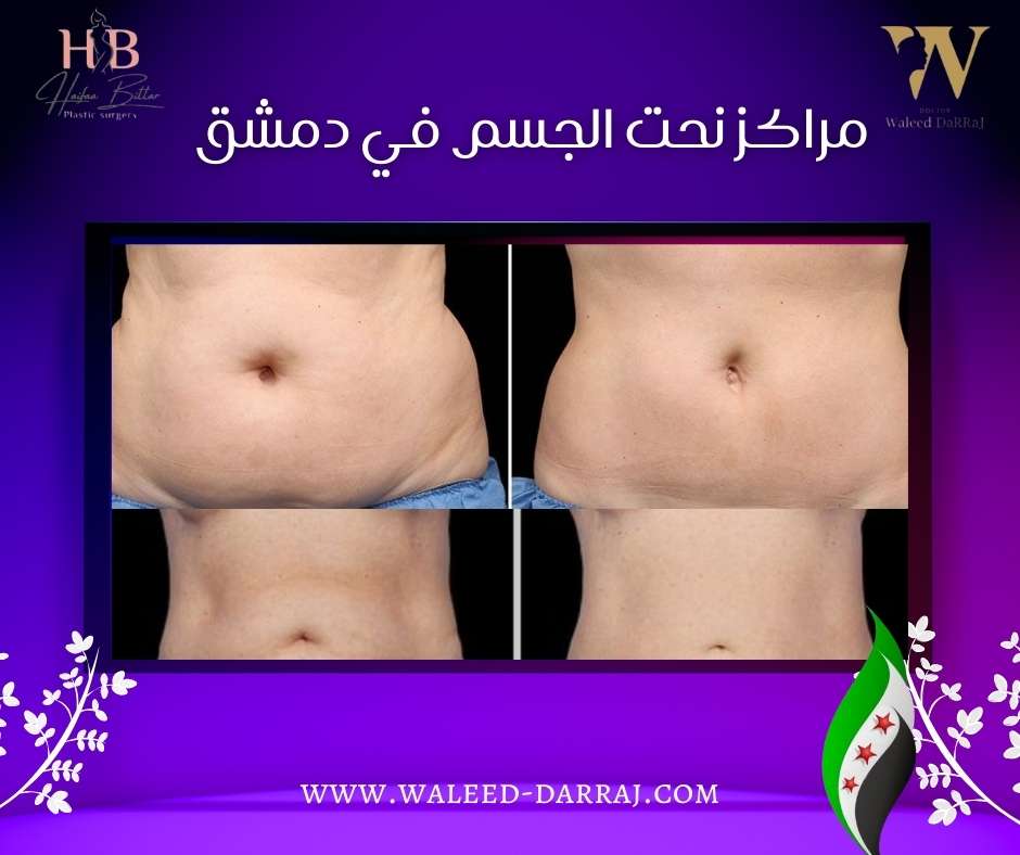 مراكز نحت الجسم في دمشق