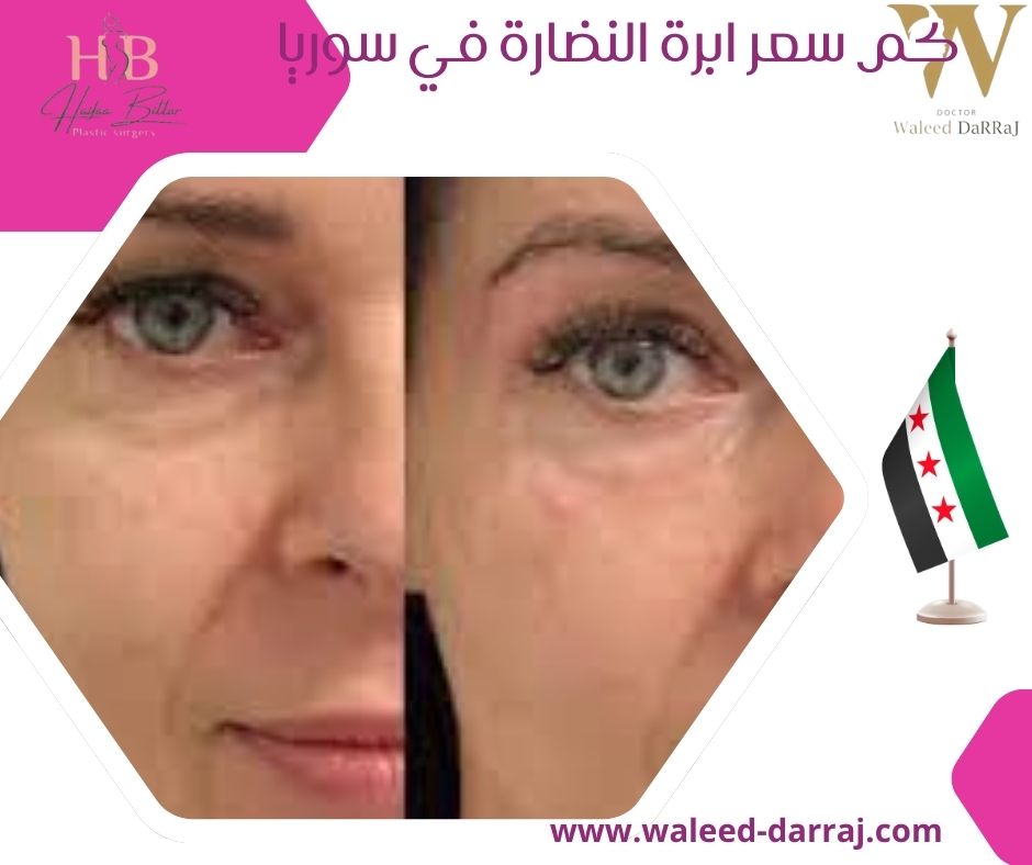 كم سعر ابرة النضارة في سوريا