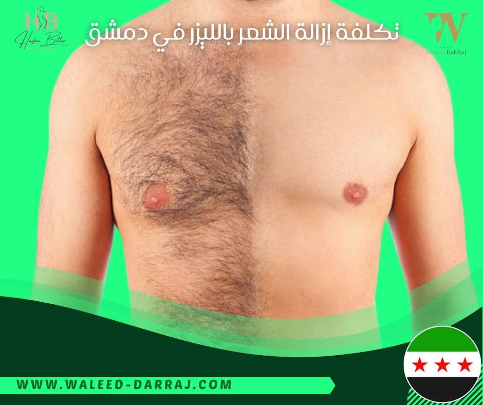 تكلفة إزالة الشعر بالليزر في دمشق