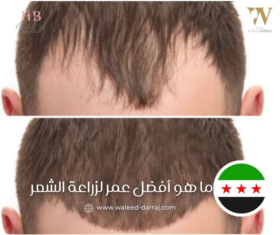 ما هو أفضل عمر لزراعة الشعر