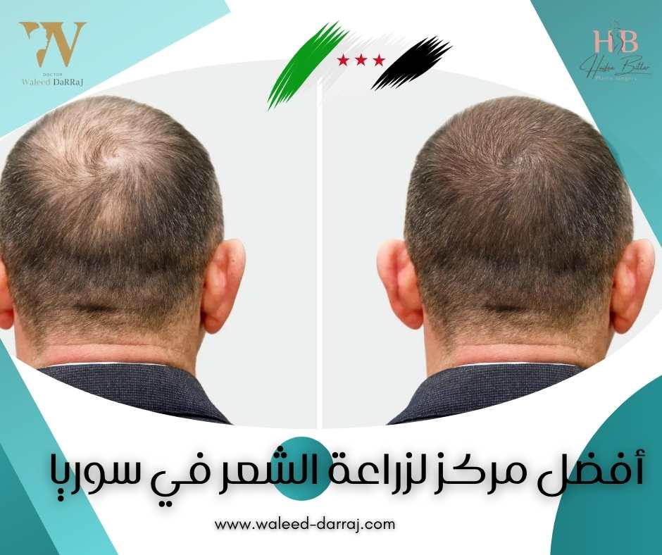 أفضل مركز لزراعة الشعر في سوريا
