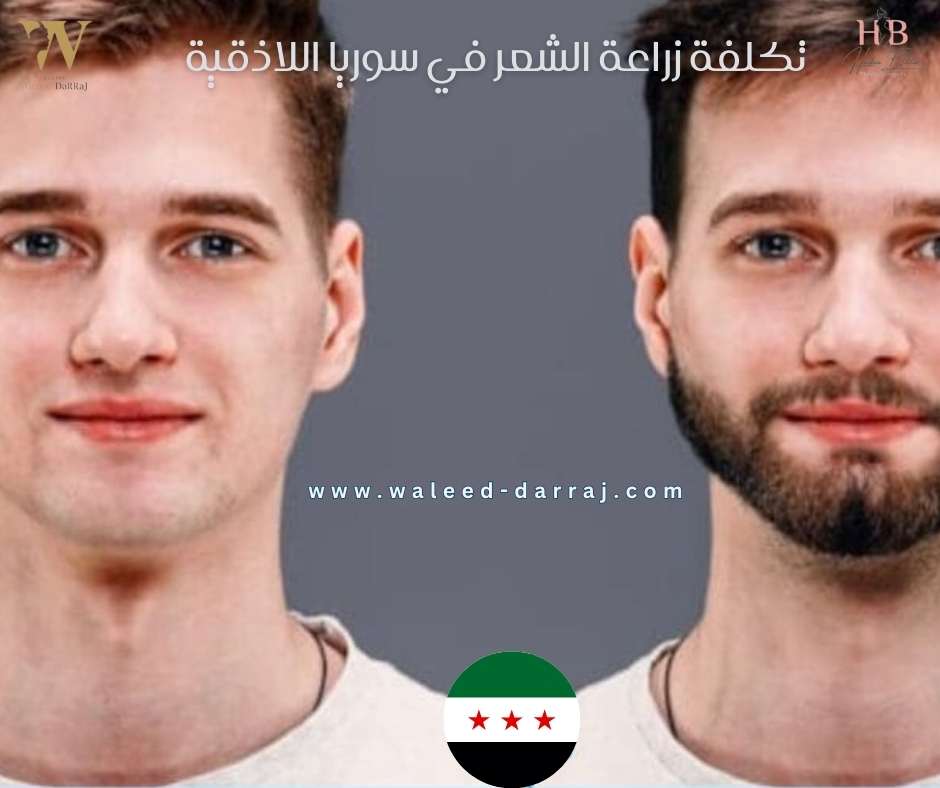 تكلفة زراعة الشعر في سوريا اللاذقية