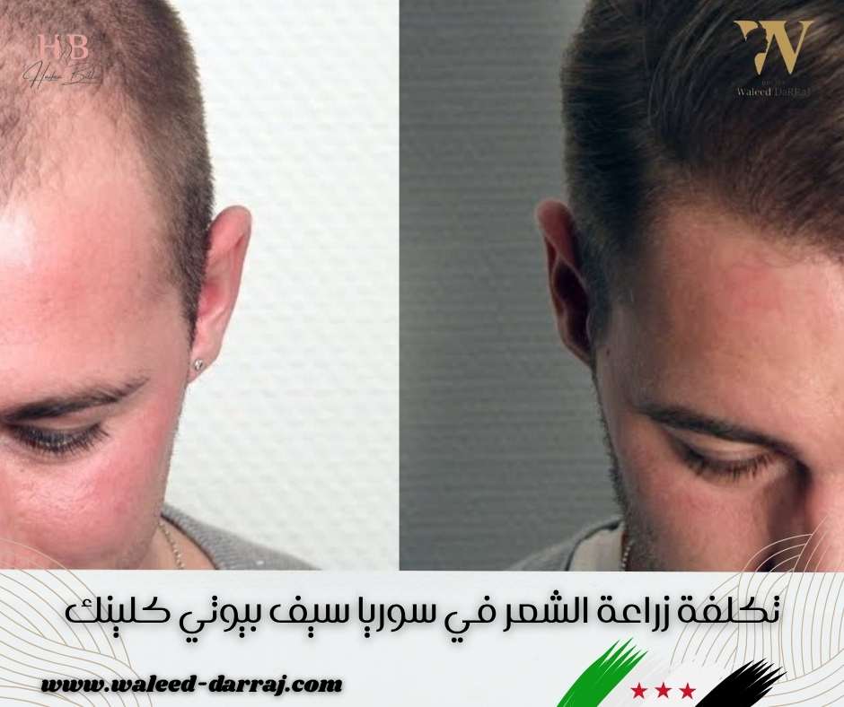 تكلفة زراعة الشعر في سوريا سيف بيوتي كلينك