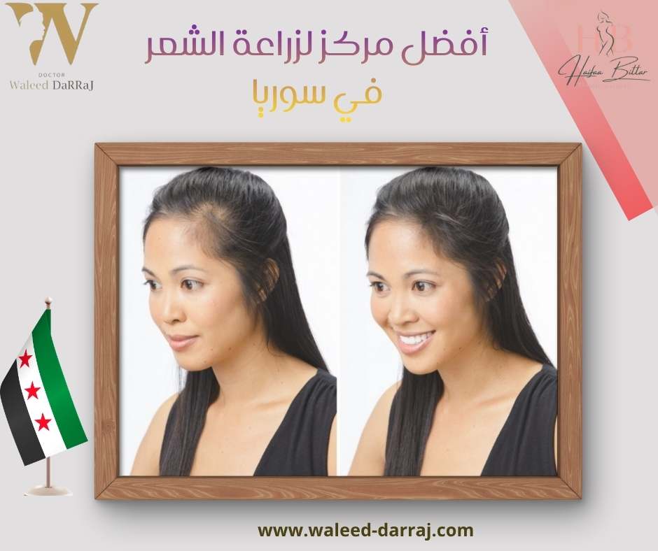 أفضل مركز لزراعة الشعر في سوريا