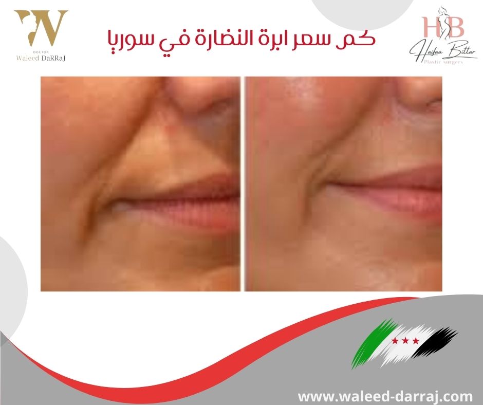 كم سعر ابرة النضارة في سوريا