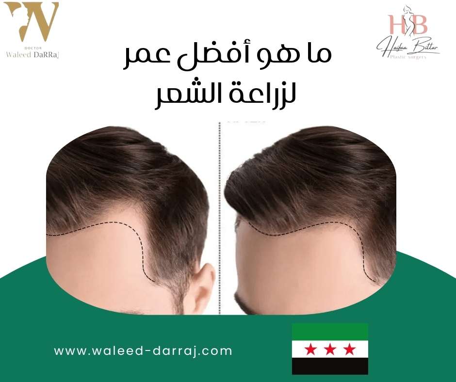 ما هو أفضل عمر لزراعة الشعر