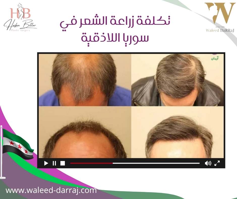 تكلفة زراعة الشعر في سوريا اللاذقية