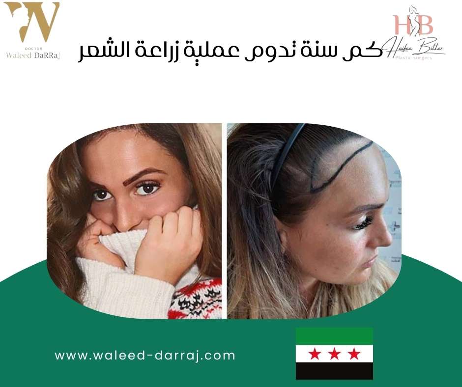 كم سنة تدوم عملية زراعة الشعر؟