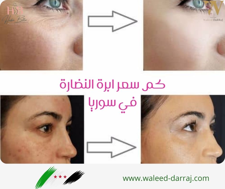 كم سعر ابرة النضارة في سوريا