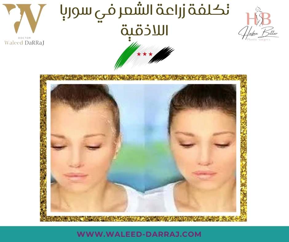 تكلفة زراعة الشعر في سوريا اللاذقية