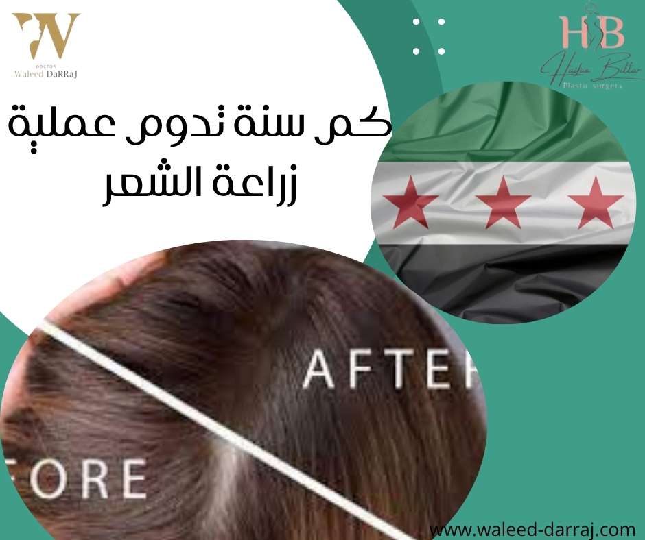 كم سنة تدوم عملية زراعة الشعر؟