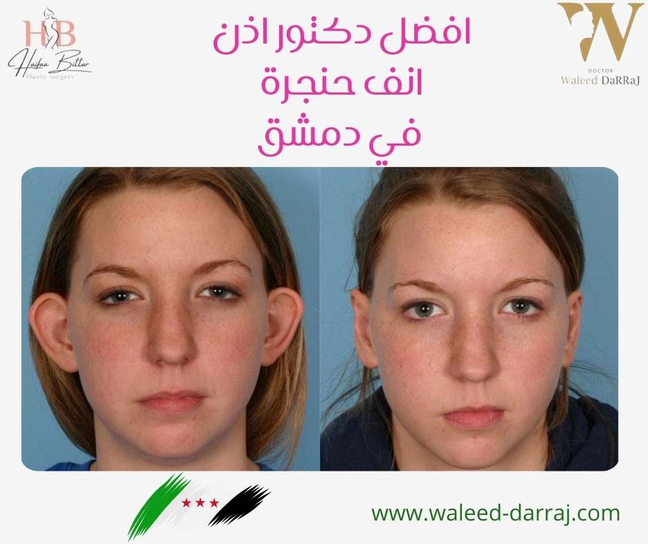 افضل دكتور اذن انف حنجرة في دمشق