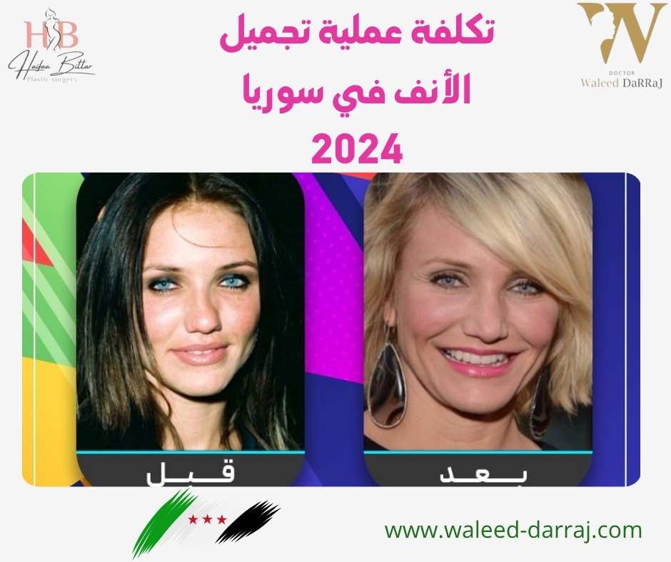 تكلفة عملية تجميل الأنف في سوريا 2024