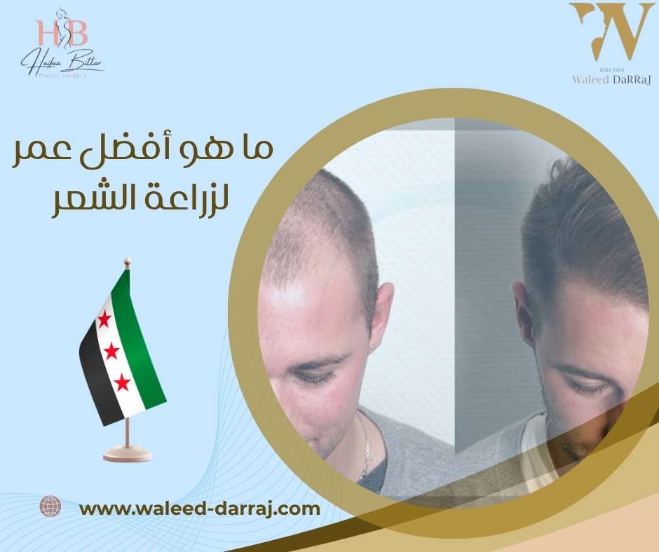 ما هو أفضل عمر لزراعة الشعر