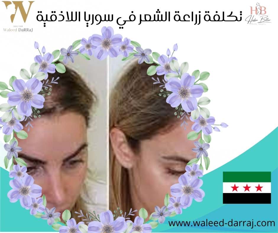 تكلفة زراعة الشعر في سوريا اللاذقية