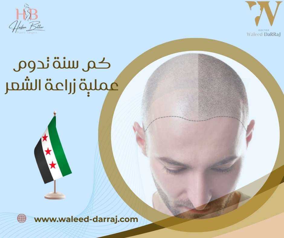 كم سنة تدوم عملية زراعة الشعر؟