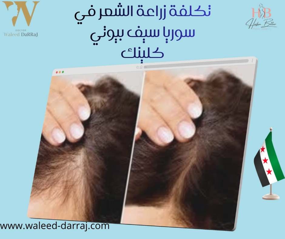 تكلفة زراعة الشعر في سوريا سيف بيوتي كلينك