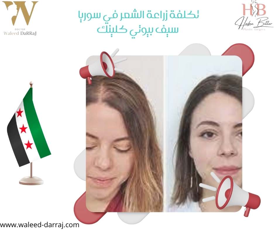 تكلفة زراعة الشعر في سوريا سيف بيوتي كلينك