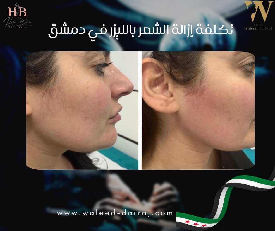 تكلفة إزالة الشعر بالليزر في دمشق