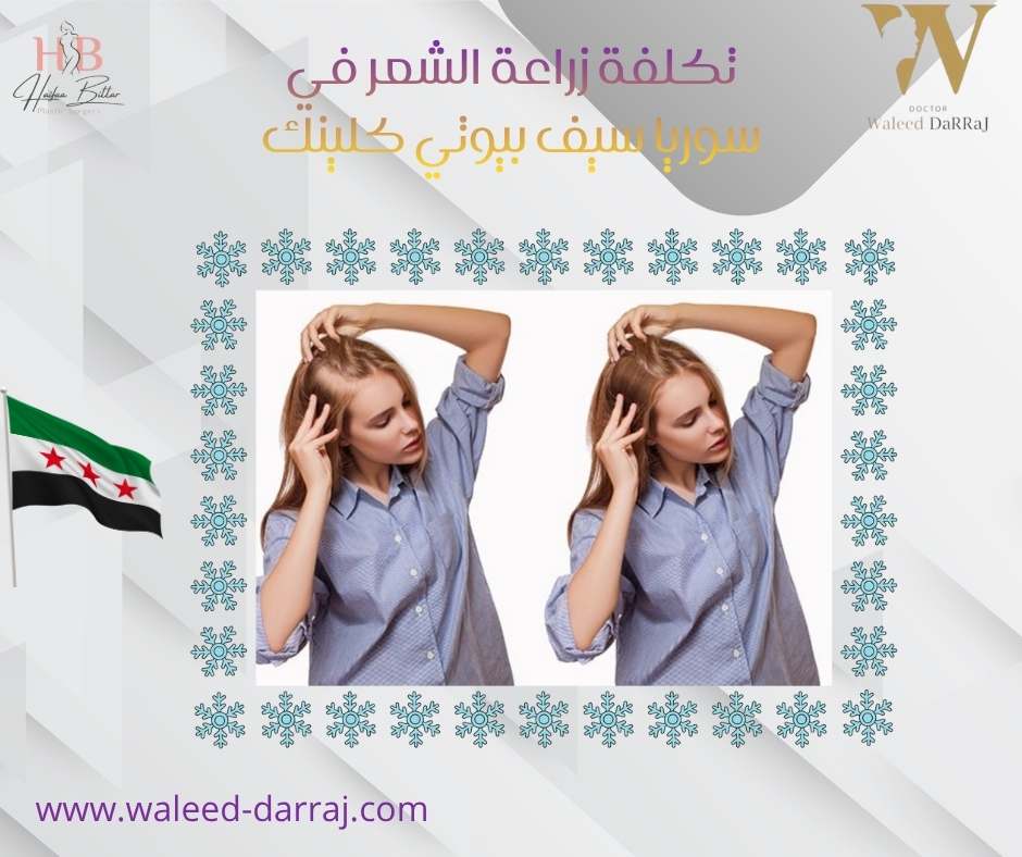 تكلفة زراعة الشعر في سوريا سيف بيوتي كلينك