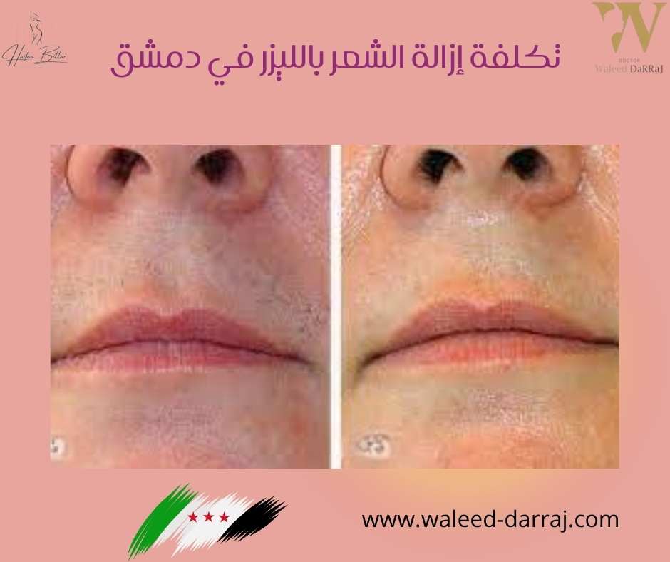 تكلفة إزالة الشعر بالليزر في دمشق