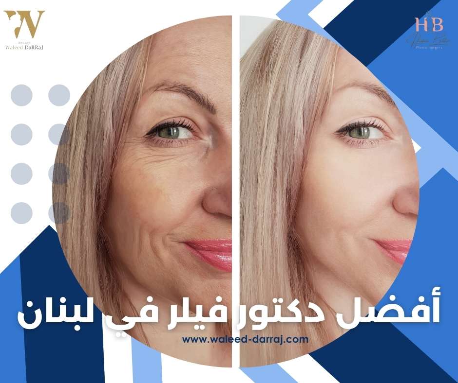 أفضل دكتور فيلر في لبنان