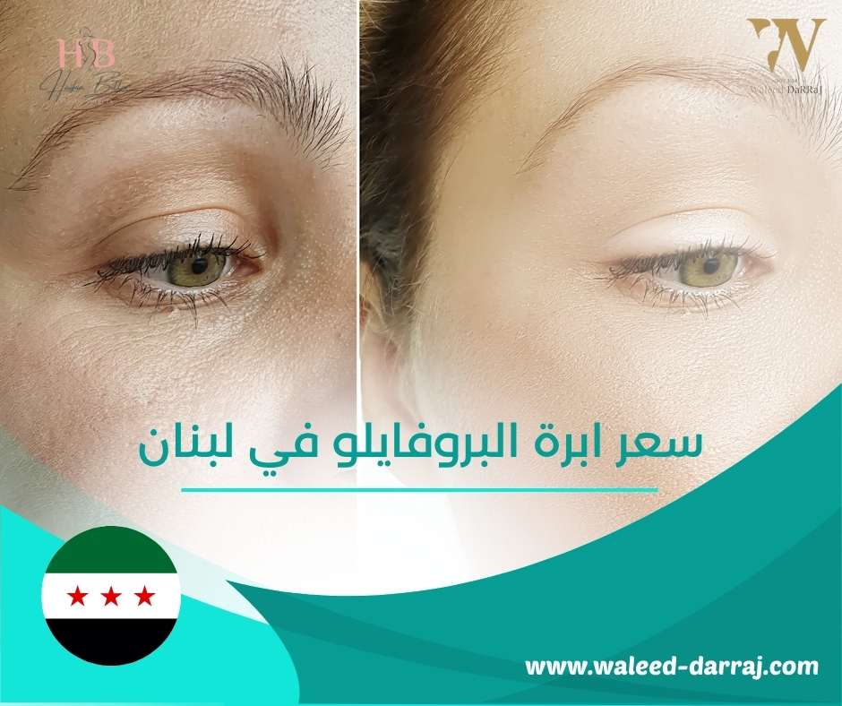 سعر ابرة البروفايلو في لبنان