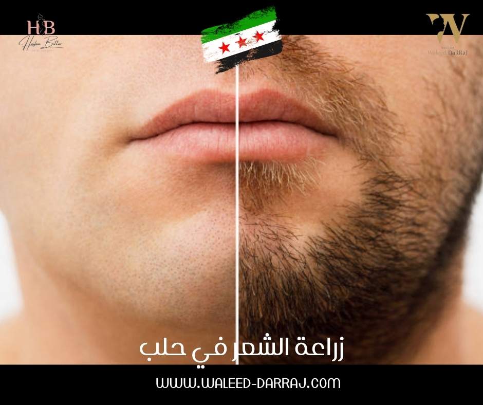 زراعة الشعر في حلب